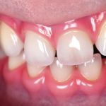 Closeup-snapshot-teeth-undergoing-orthodontic-treatment