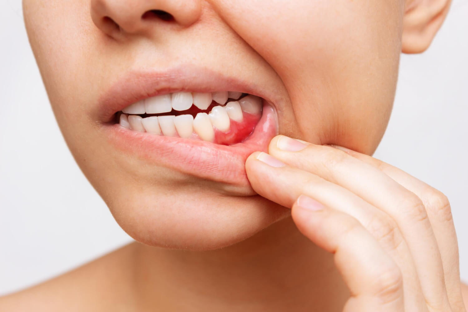 Gum inflammation cropped shot young woman showing red bleeding gums