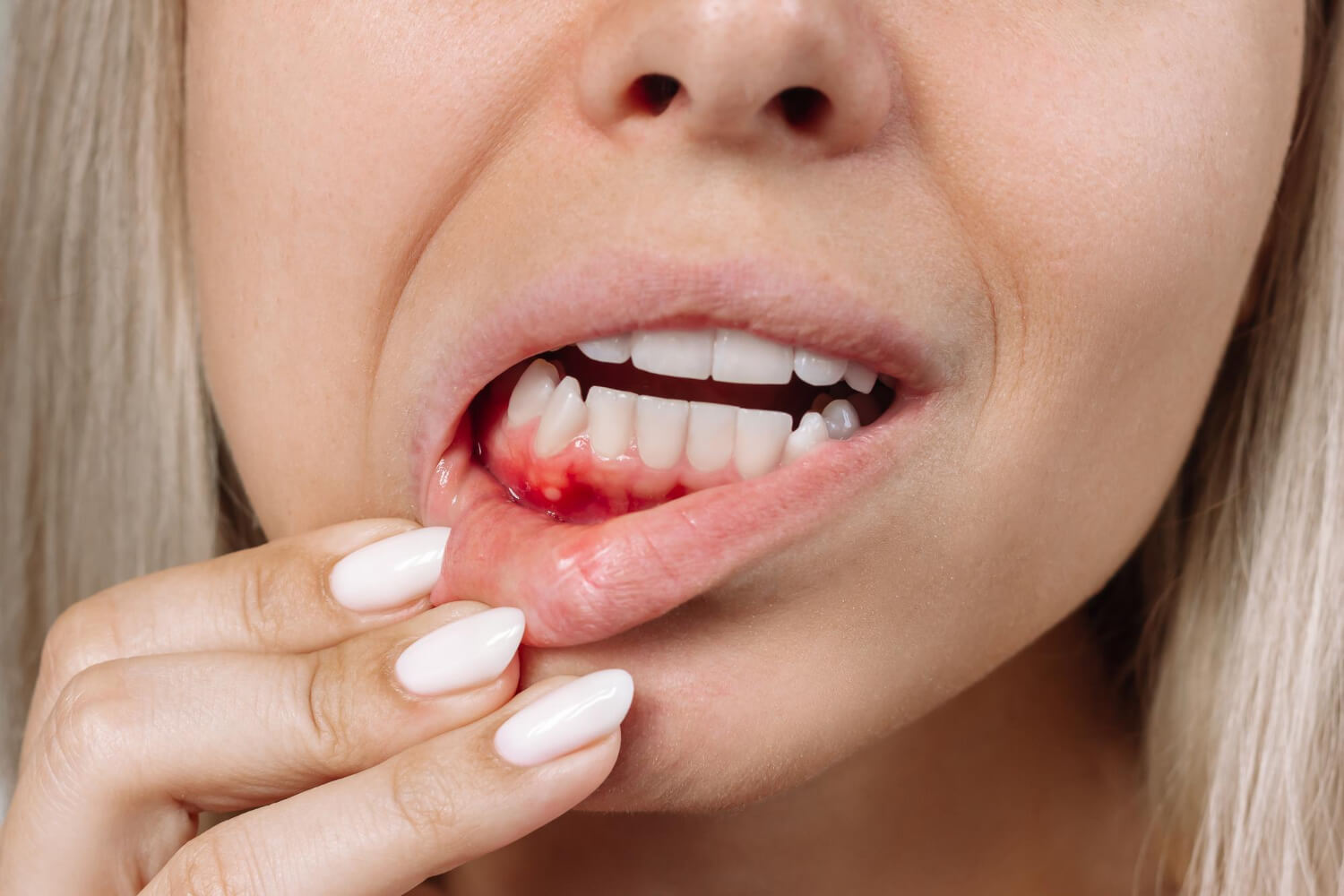 stomatitis gums red bleeding show by female