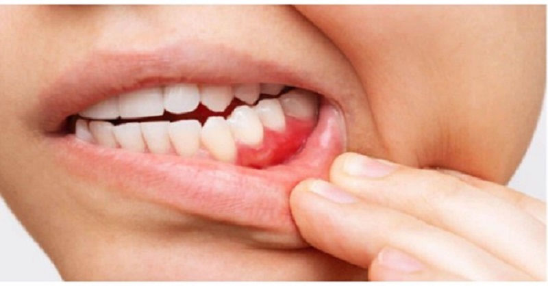 how to stop bleeding from a tooth extraction