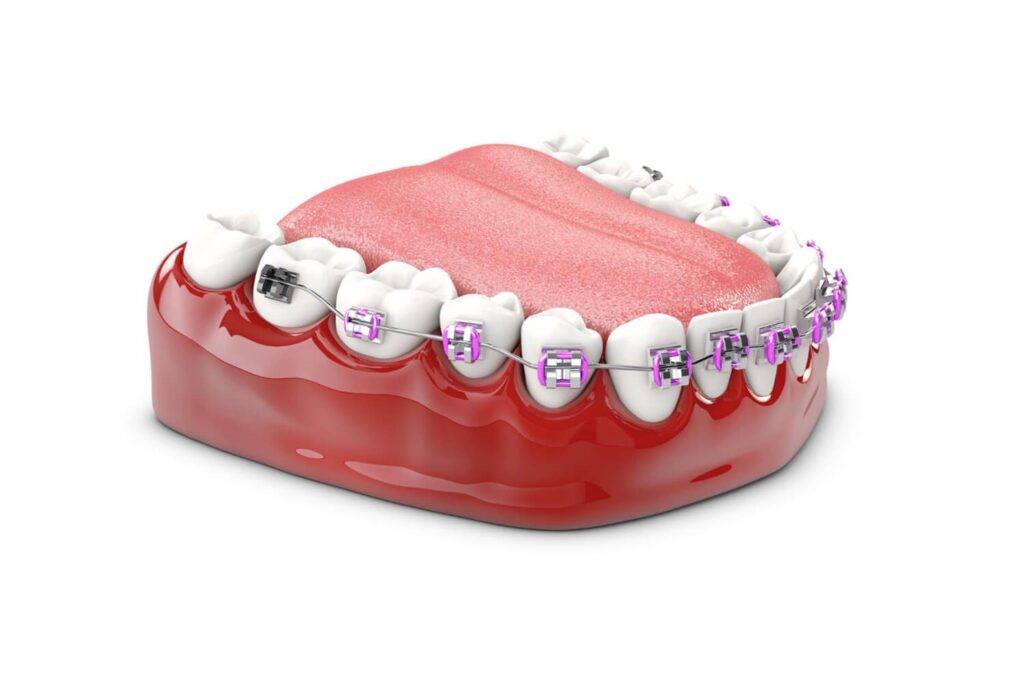 SureSmile clear aligners work