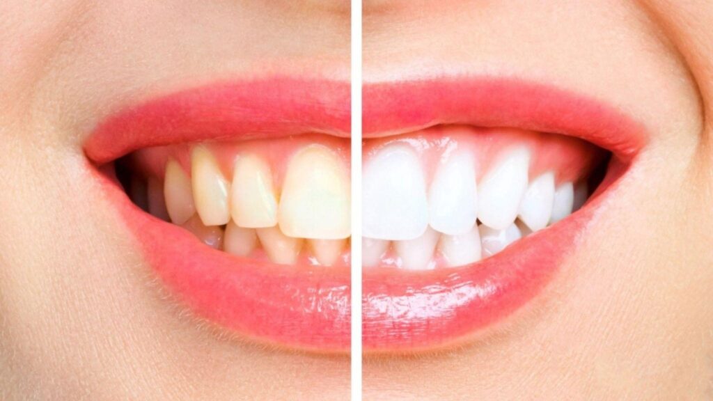Teeth Whitening Burton