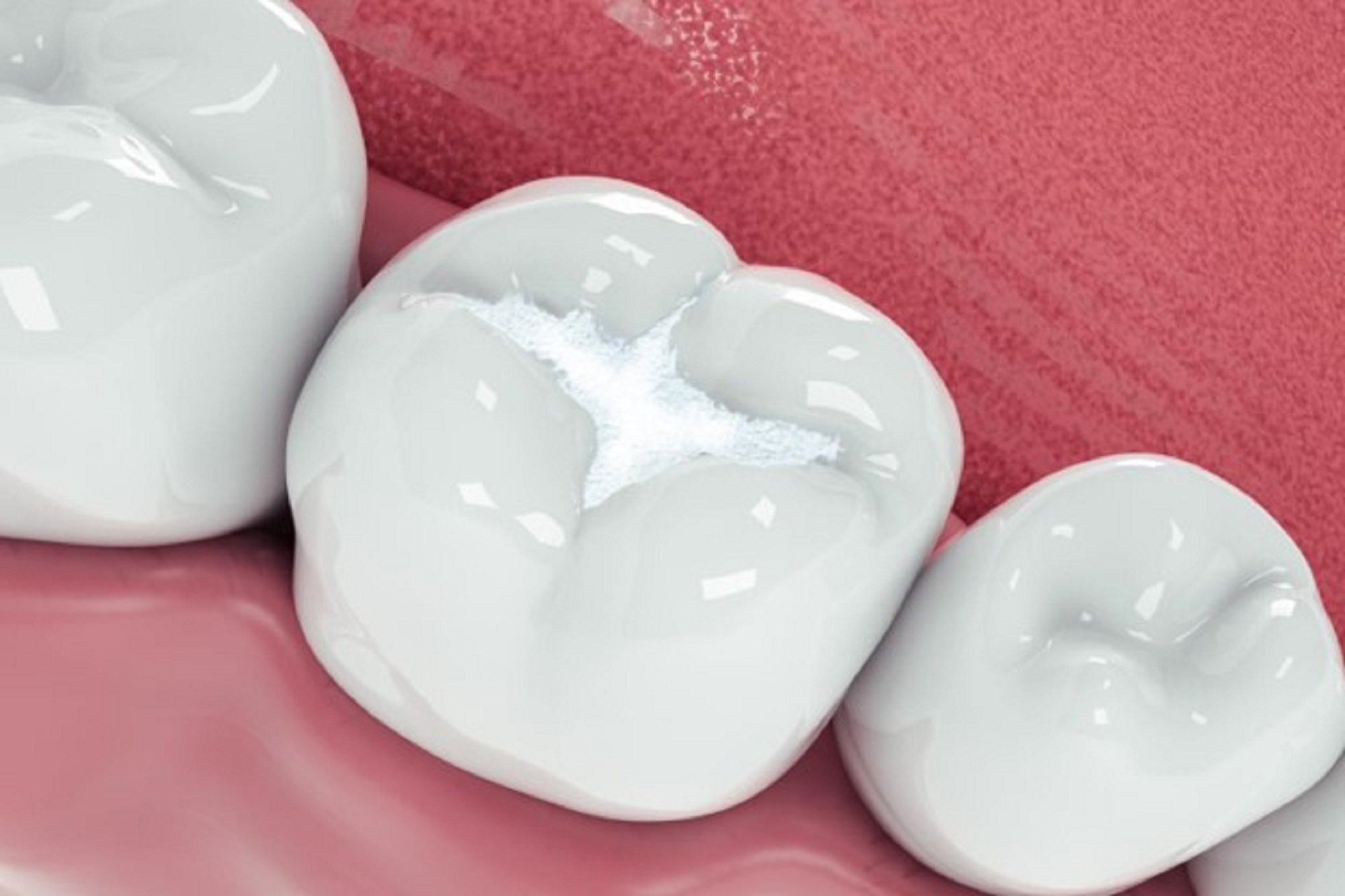 Risks of getting a filling when you need a dental crown