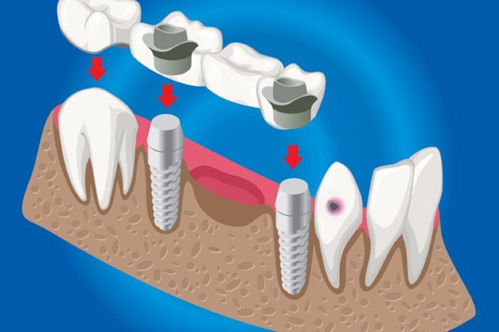 when is a dental crown needed