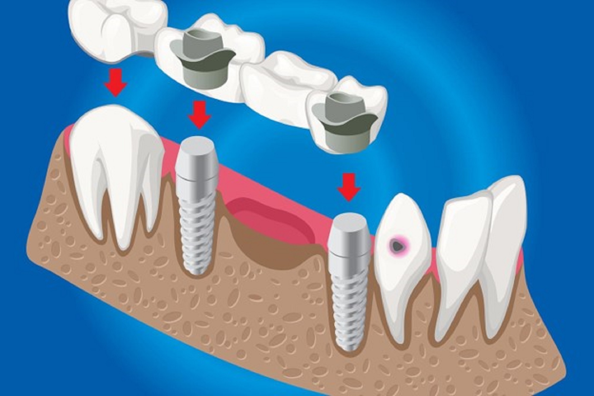 when is a dental crown needed