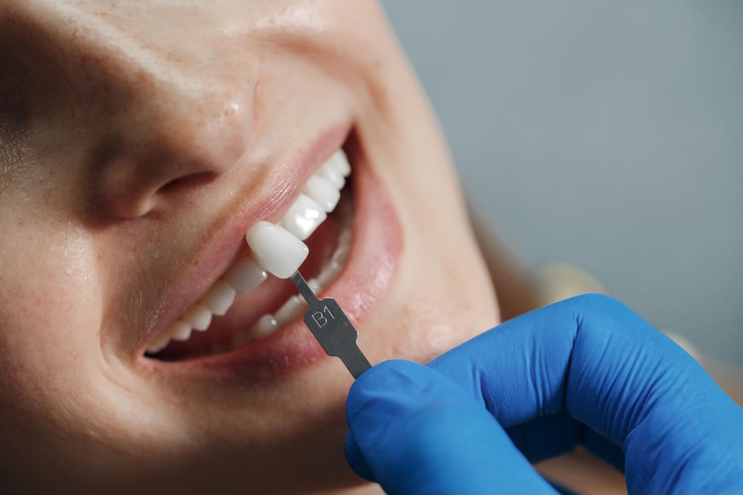 Porcelain dental veneers treatment for improving the appearance of teeth
